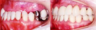 矯正歯科/反対咬合の成人矯正歯科治療前後の歯ならびかみ合わせの変化