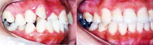 矯正歯科/歯肉炎を伴う叢生の成人矯正歯科治療前後の歯ならびかみ合わせの変化