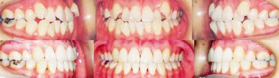 矯正歯科/デコボコした歯の成人矯正歯科治療前後の歯ならびかみ合わせの変化