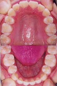 矯正歯科/予防歯科のコラボレ−ションによってきれいな歯ならび/正しいかみ合わせになってしかもムシ歯が1本もない患者さんの矯正歯科治療後の咬合面観
