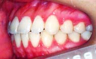 矯正歯科 / 予防歯科のコラボレ−ションによってきれいな歯ならび / 正しいかみ合わせになってしかもムシ歯が1本もない患者さん
