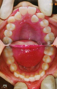 矯正歯科/予防歯科のコラボレ−ションによってきれいな歯ならび/正しいかみ合わせになってしかもムシ歯が1本もない患者さんの咬合面観