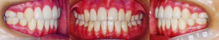矯正歯科/予防歯科のコラボレ−ションによってきれいな歯ならび/正しいかみ合わせになってしかもムシ歯が1本もない患者さん/4本の第一小臼歯を抜歯して矯正歯科治療した