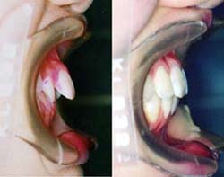 矯正歯科/予防歯科のコラボレ−ションによってきれいな歯ならび/正しいかみ合わせになってしかもムシ歯が1本もない患者さん/非抜歯で矯正歯科治療した前後の前歯と突出度の変化