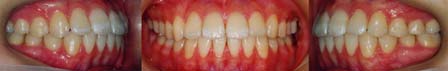 矯正歯科/予防歯科のコラボレ−ションによってきれいな歯ならび/正しいかみ合わせになってしかもムシ歯が1本もない患者さん/非抜歯（歯を抜かないで治した）