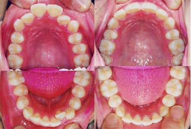矯正歯科/予防歯科のコラボレ−ションによってきれいな歯ならび/正しいかみ合わせになってしかもムシ歯が1本もない患者さんの咬合面観/4本の第一小臼歯を抜歯して矯正歯科治療した矯正歯科治療前後