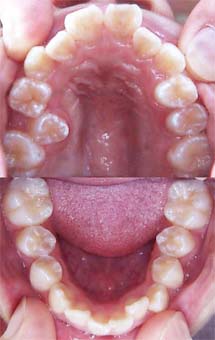 矯正歯科/予防歯科のコラボレ−ションによってきれいな歯ならび/正しいかみ合わせになってしかもムシ歯が1本もない患者さんの矯正歯科治療前の咬合面観