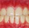 矯正歯科治療完了時点で1本もムシ歯がなかった患者さん１