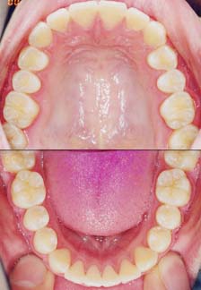 矯正歯科/予防歯科のコラボレ−ションによってきれいな歯ならび/正しいかみ合わせになってしかもムシ歯が1本もない患者さんの咬合面観