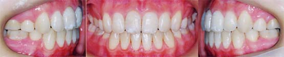 矯正歯科/予防歯科のコラボレ−ションによってきれいな歯ならび/正しいかみ合わせになってしかもムシ歯が1本もない患者さん/4本の第一小臼歯を抜歯して矯正歯科治療した