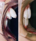 矯正歯科/予防歯科のコラボレ−ションによってきれいな歯ならび/正しいかみ合わせになってしかもムシ歯が1本もない患者さん/4本の第一小臼歯を抜歯して矯正歯科治療した前後の前歯の突出度の変化
