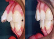 矯正歯科/予防歯科のコラボレ−ションによってきれいな歯ならび/正しいかみ合わせになってしかもムシ歯が1本もない患者さん/4本の第一小臼歯を抜歯して矯正歯科治療後の前歯の突出度の変化