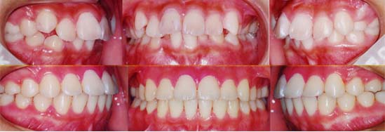 矯正歯科/予防歯科のコラボレ−ションによってきれいな歯ならび/正しいかみ合わせになってしかもムシ歯が1本もない患者さん/非抜歯（歯を抜かないで治した）