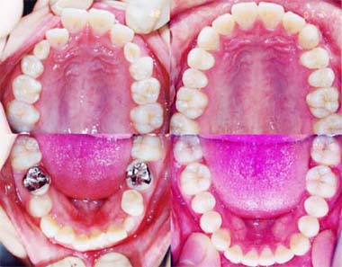 矯正歯科/予防歯科のコラボレ−ションによってきれいな歯ならび/正しいかみ合わせになってしかもムシ歯が1本もない患者さんの矯正歯科治療前後の咬合面観