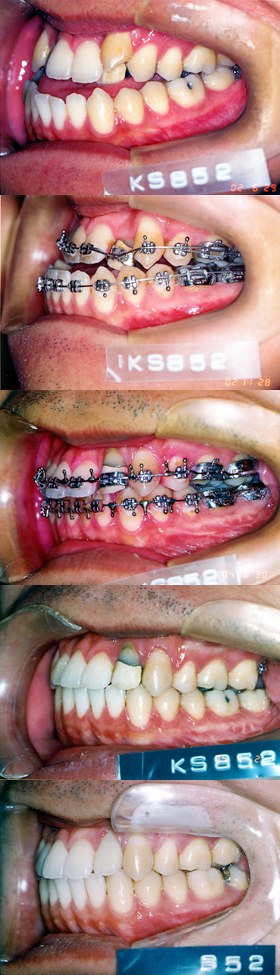 外科手術を伴う顎変形症 症例