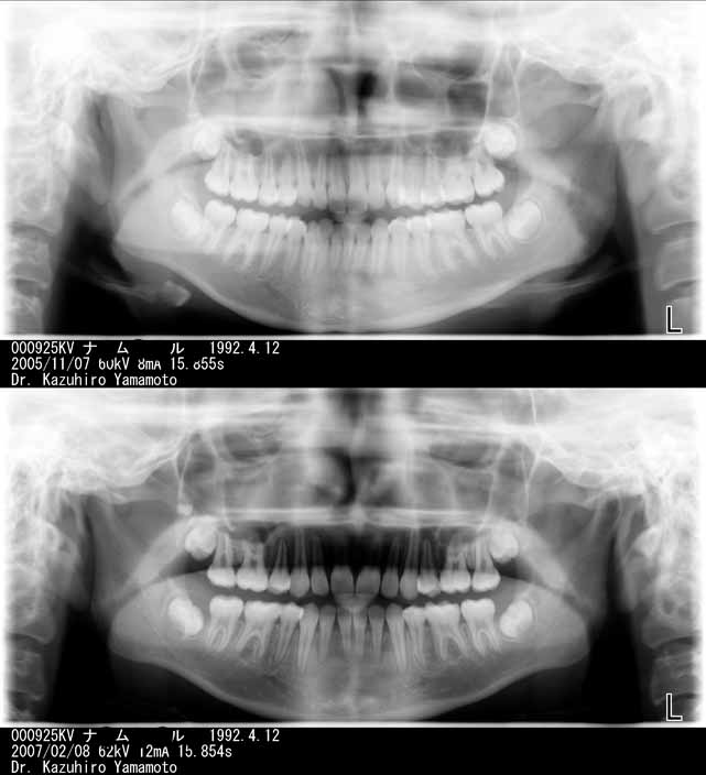 矯正歯科動的治療期間1年でフィニッシュした患者さんのレントゲン写真