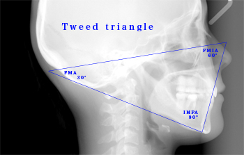 矯正歯科治療における抜歯/非抜歯の診断の判定基準に用いられるTweedの三角