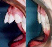 上顎前突成人矯正歯科治療前後の前歯の変化