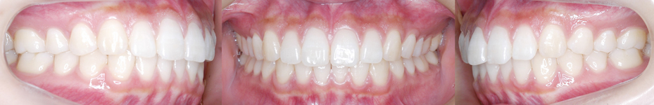 非抜歯矯正歯科治療例